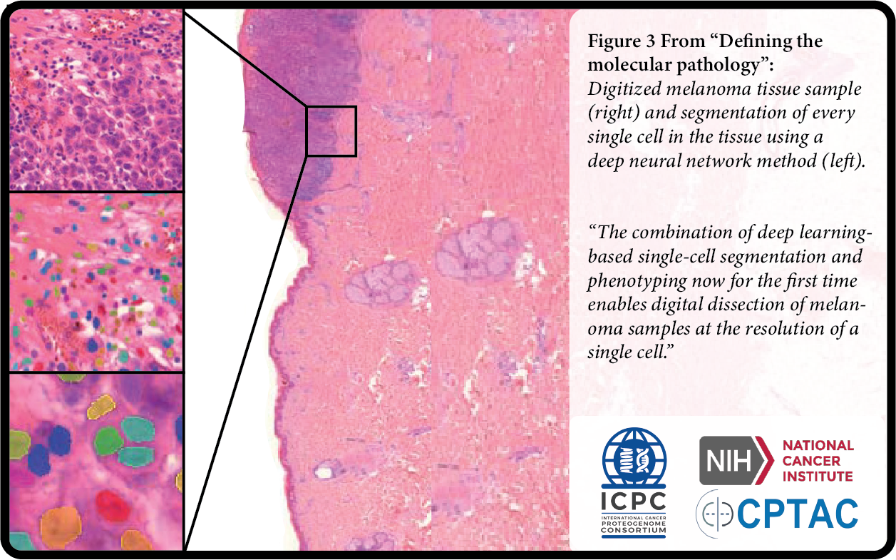 the-human-melanoma-proteome-atlas-proteogenomic-researchers-map-protein-expression-in-malignant